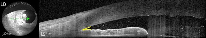 Figure 1B. Anterior segment optical coherence tomography showing a shallow anterior chamber and a narrow irido-corneal angle (outlined in yellow).