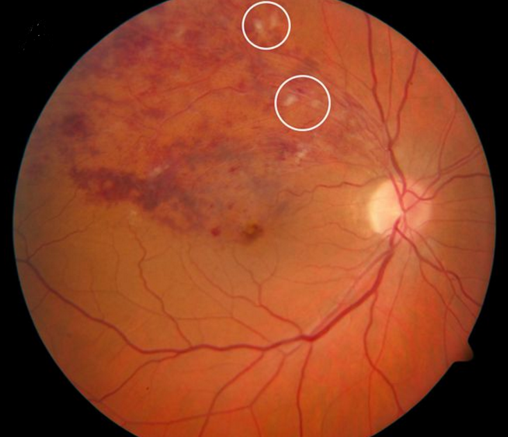 Branch retinal vein occlusion