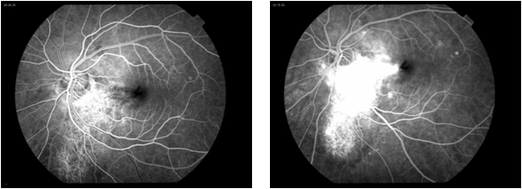 Fa choroidal osteoma.png