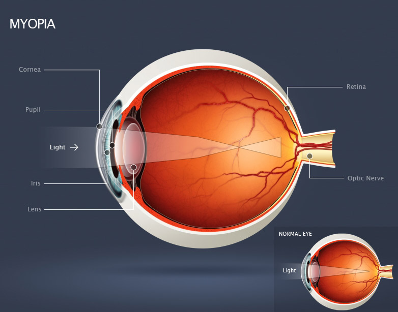 Myopia; light is focused in front of the retina