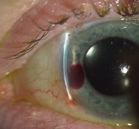 Figure 17: postoperative complication - Descemet rupture with intracorneal blood