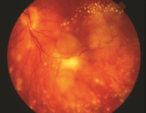 Severe sarcoid panuveitis