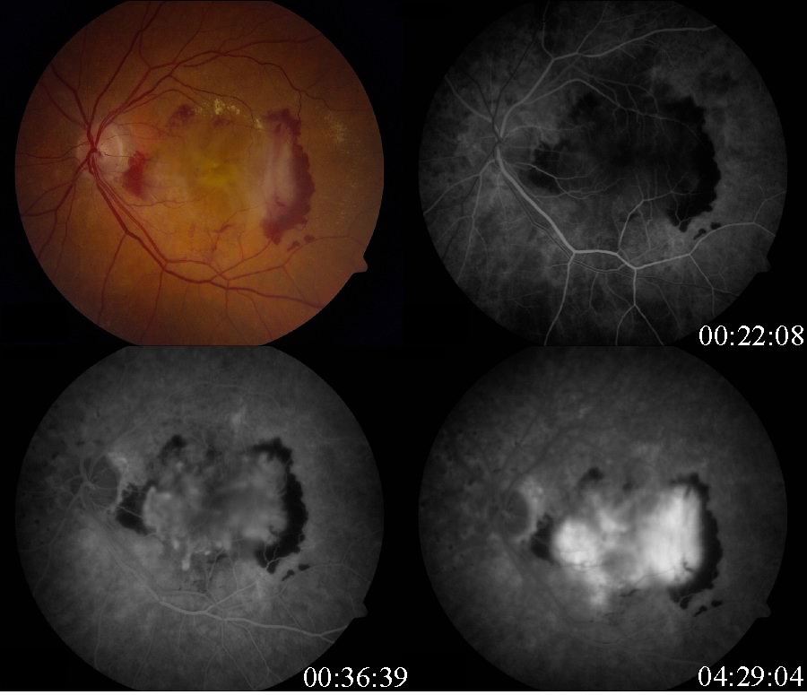 Classic choroidal neovascular membrane in exudative age-related macular degeneration