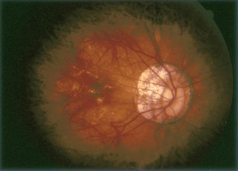 Pathologic myopia with tilted disc and peripapillary atrophy of RPE and choroid.