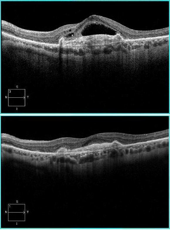 OCT Wet AMD Treated.JPG