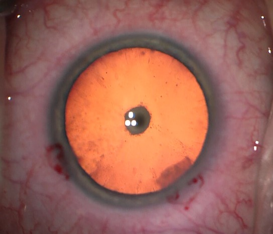 Central posterior polar cataract.jpeg