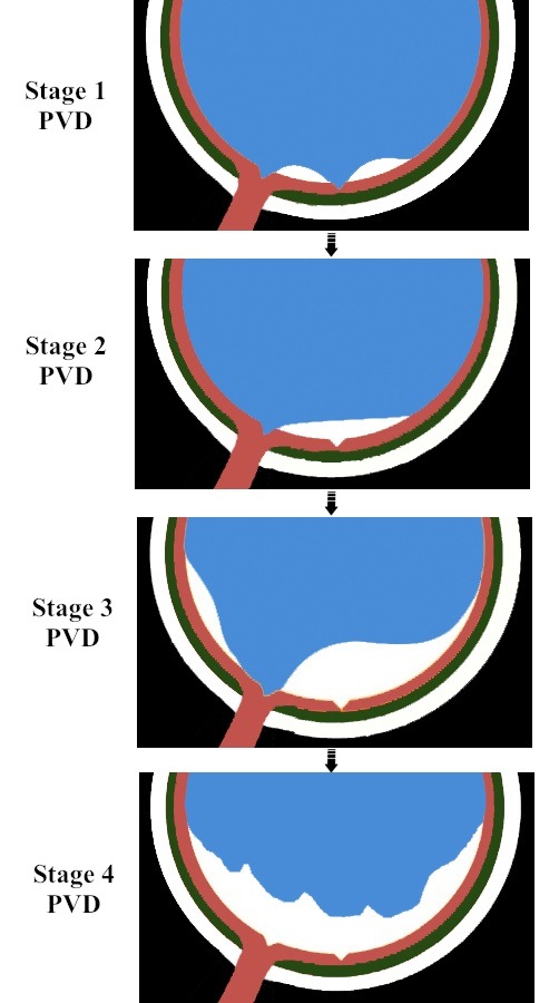 Evolution of PVD Stages.jpg