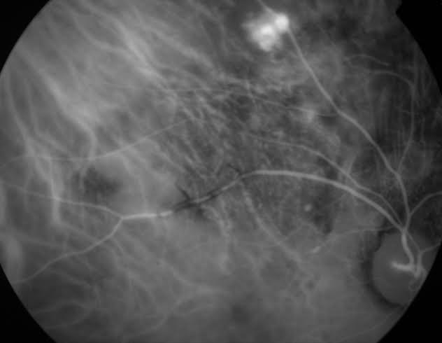 ICGA of polyps in the choroidal vasculature. Image courtesy of Dr. Gelareh Abedi.