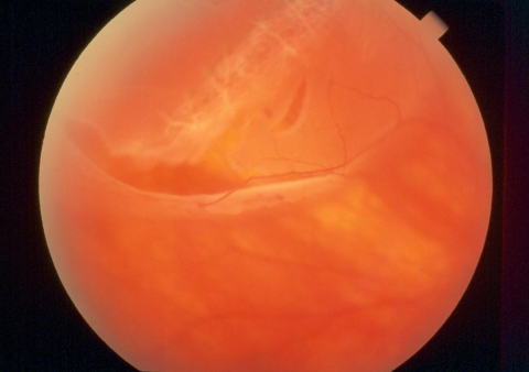 Retinal detachment