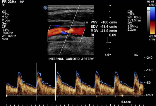 Carotiddup.jpg