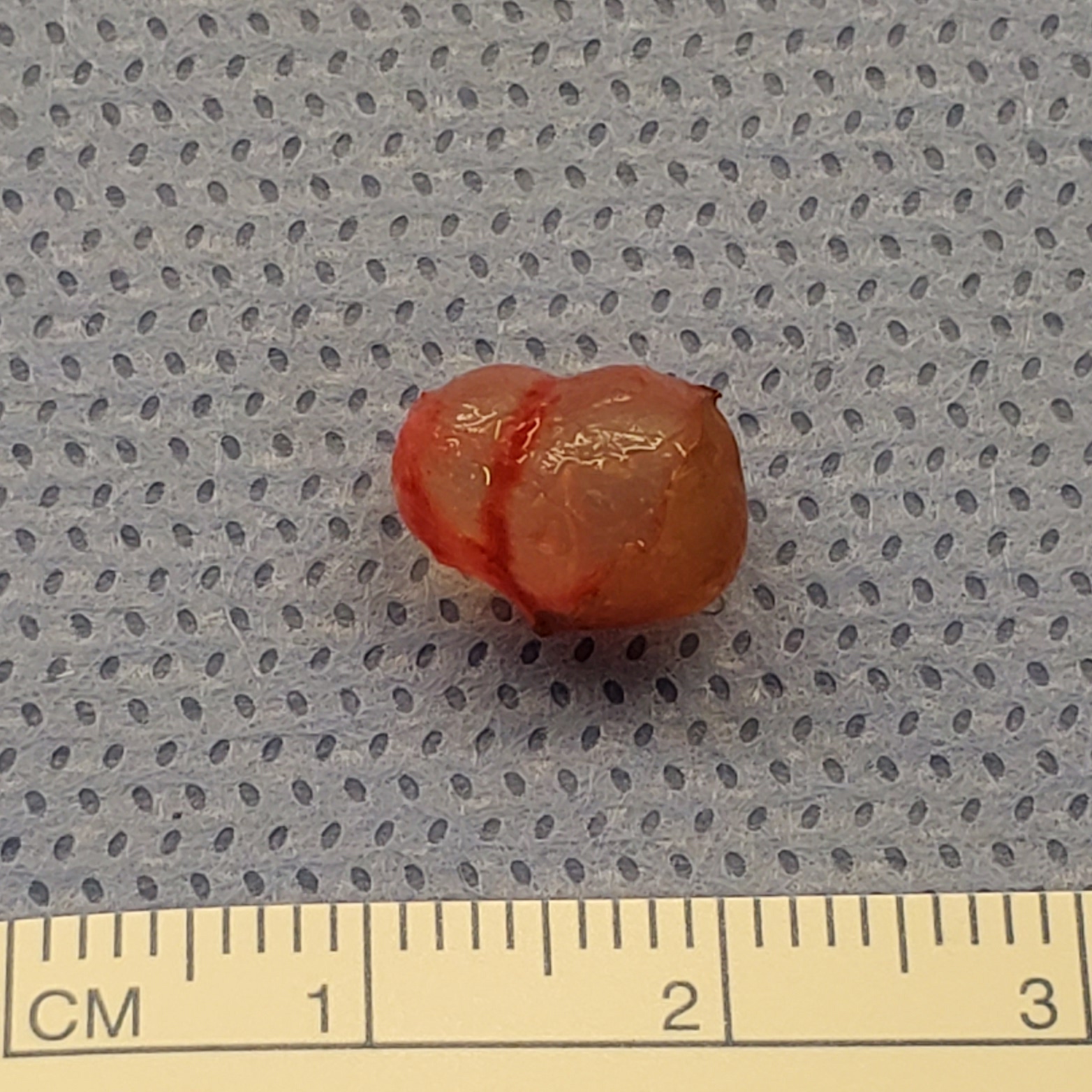 Eccrine hidrocystoma surgical specimen