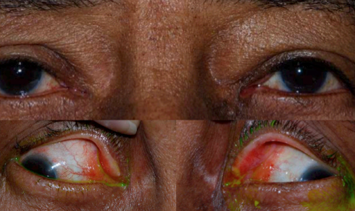 Figure 1: Conjunctival amyloidosis. Smooth, waxy, yellow, relatively circumscribed masses are seen at bilateral medial canthi. Visualization of the lesions is improved with lateral gaze. (Image courtesy of Gary S. Lissner, MD)