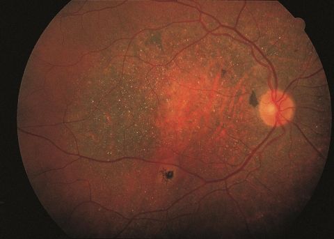 Bietti crystalline dystrophy.