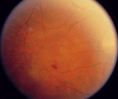 Pigment epithelial detachment