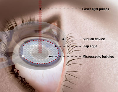 Figure 5. Illustration of a femtosecond laser cutting a LASIK flap.