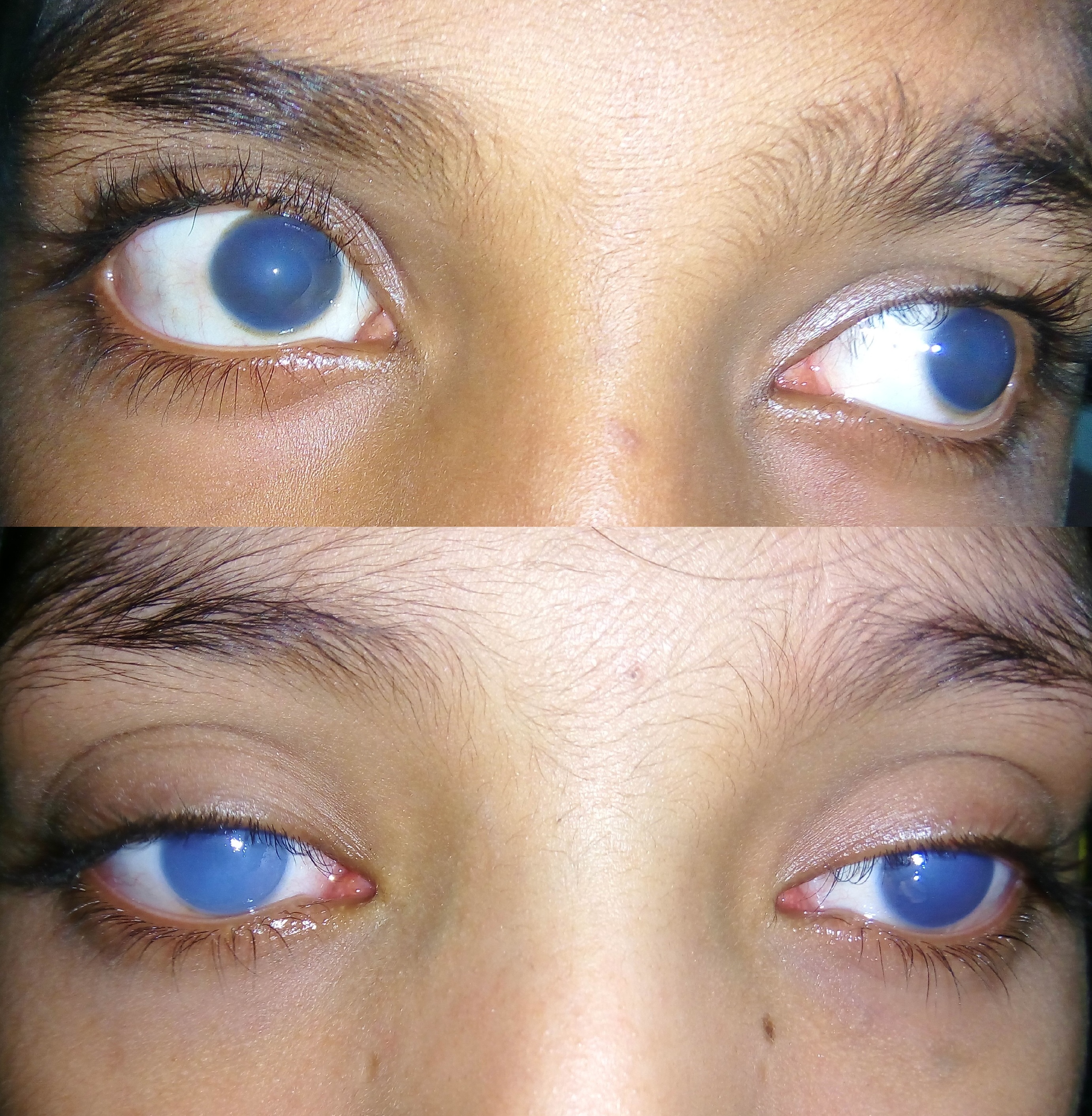 Two siblings (Upper one brother, lower one sister) of consanguineous parents suffering from CHED.