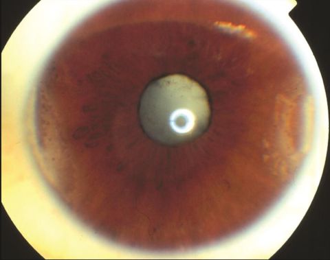 Band keratopathy and white cataract in a patient with juvenile idiopathic arthritis.