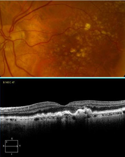 Drusen with corresponding OCT.JPG