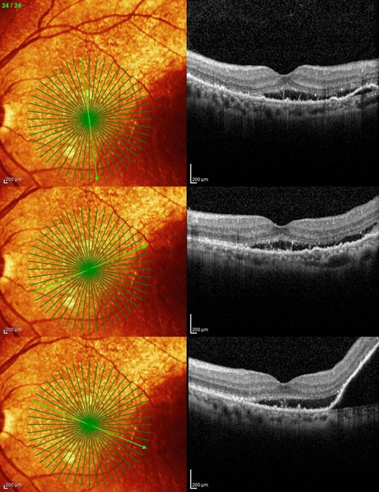 Figure 2. Spectral domain OCT of left macula of patient with suspected PCV.