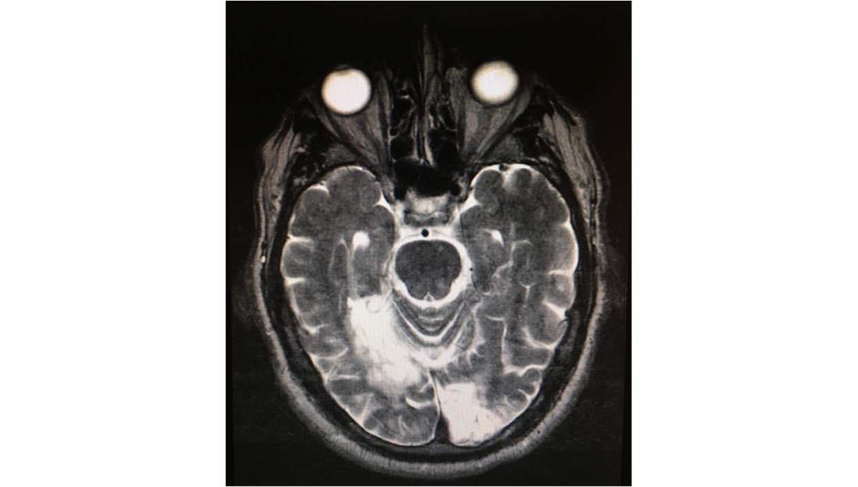 Bilateral occipital lobe infarcts