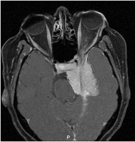 FIGURE 5: Axial T1 post gadolinium MRI image showing a diffuse sphenoid wing meningioma involving the left orbital apex, and cavernous sinus exerting a mass effect on the pons and orbital structures. The image shows the typical appearance of meningioma signified by thickening with sparing of adjacent anatomical structures, as well as exhibiting prominent contrast enhancement and a dural tail.