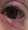 Clinical photo of patient with MIRM with conjunctival injection and ulceration of lid margin.