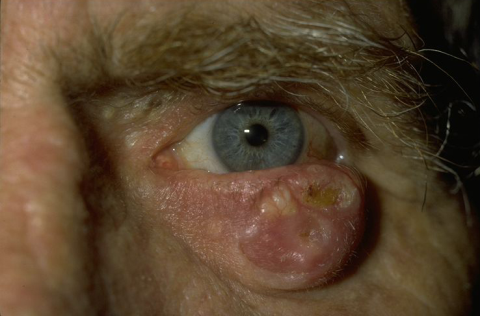 Squamous Cell Carcinoma.