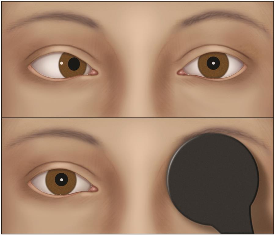 The cover test can be used to assess for strabismus.