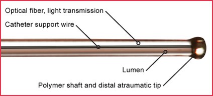 Figure 6: microcatheter has a lumen for OVD injection