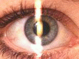 Retinoscopy.myopia.gif