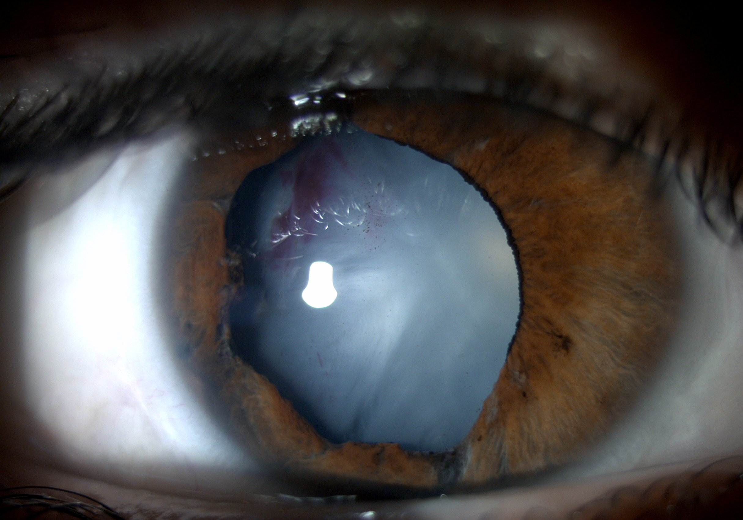 Intumescent white cataract