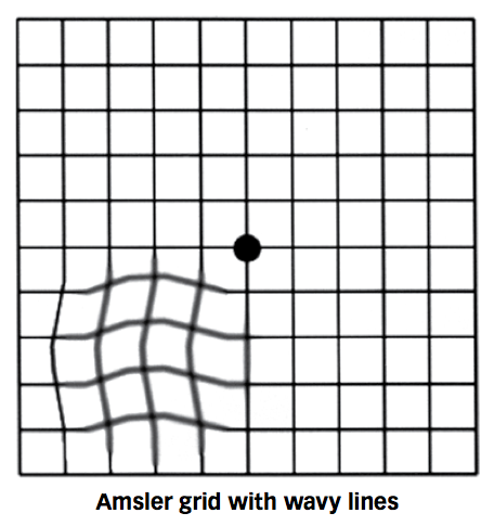 Neuroretinitis Amsler.png