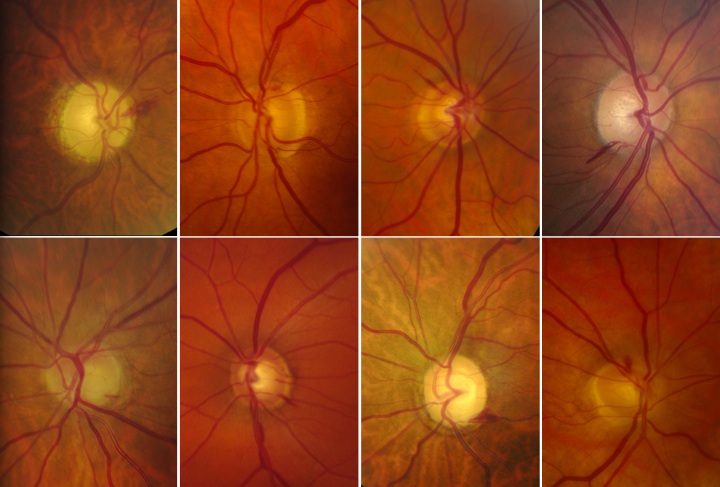 Optic Disc Hemorrhage - EyeWiki