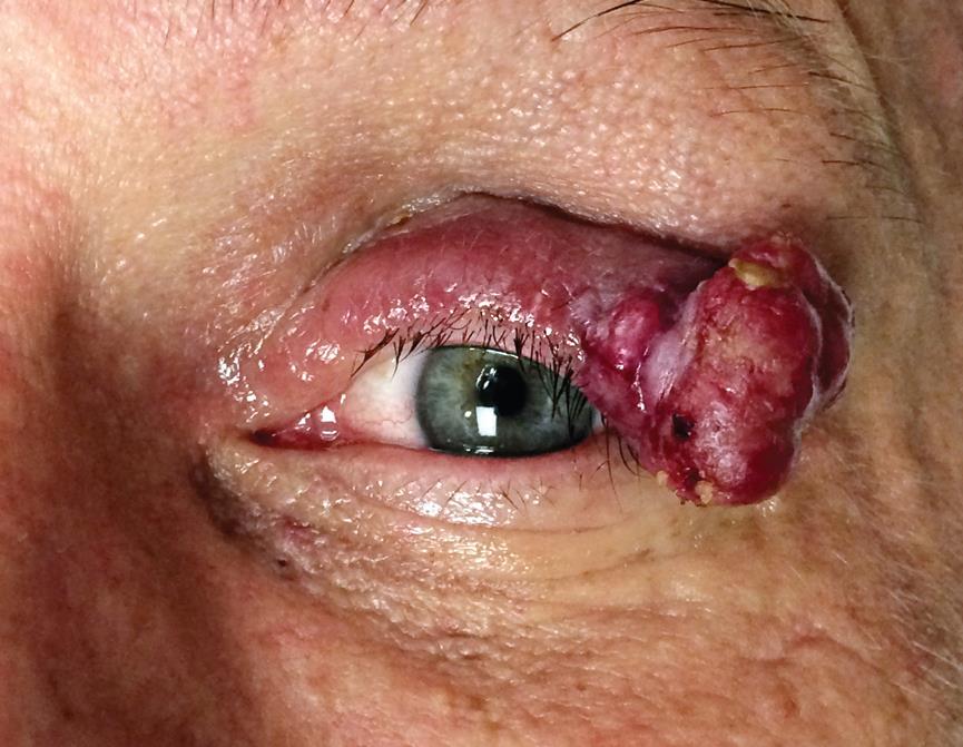 Merkel cell carcinoma of the left upper eyelid.