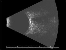 Plaque-like calcification and acoustic shadowing