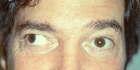 Exotropia, right eye (adult)