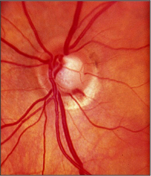 Optic disc photograph of a left eye demonstrating a hemorrhage occurring at the inferotemporal rim.