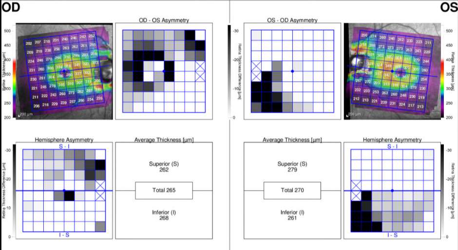 Spectralis Asymmetry analysis.PNG