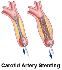 Stent.jpg