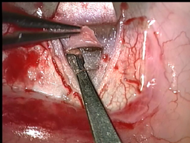 Figure 9: Deep scleral flap dissection