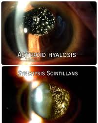 Compare Asteroid Hyalosis and Synchysis Scintillans