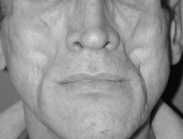 Facial Lipoatrophy