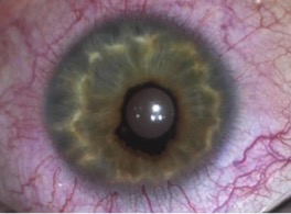 External photo demonstrating ectropion uveae and corectopia