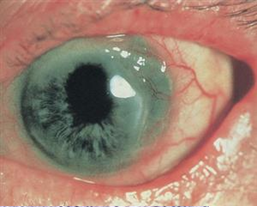 Mooren’s ulcer. Crescent-shaped ulceration with an overhanging central edge and a vascularized base are seen in the temporal periphery of the cornea. Ⓒ 2014 American Academy of Ophthalmology.