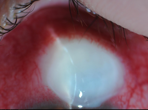 Slide 3. Image showing characteristic “white-on-red” appearance of acute blebitis. Note the slit beam demonstrating the area of marked thinning that corresponds to the leak shown in Slide 2. Also note the avascularity and tenseness of the bleb.