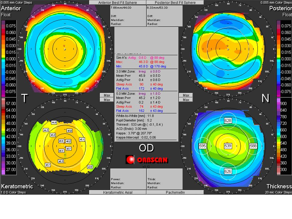 Figure 4 a : Normal Orbscan Quad Map