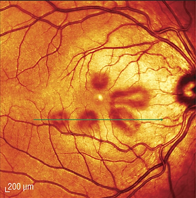 Acute Macular Neuroretinopathy.jpg