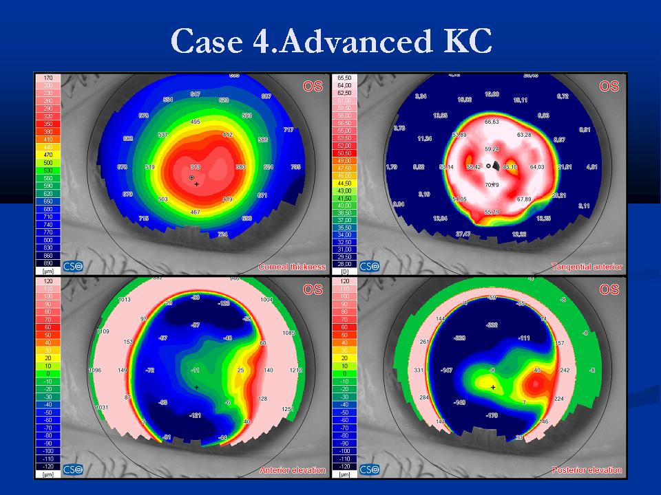 Case examples topography GPrakash (8).JPG