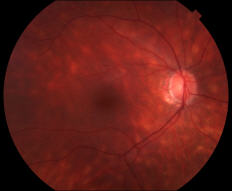 Birdshot Retinochoroidopathy