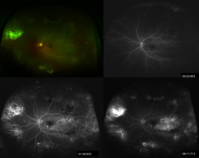 Figure 3. Wide field Optos® of left eye with fluorescein angiography at 22s, 1:45s, and 8:11s demonstrating multiple areas of hemorrhages and serous retinal detachments.